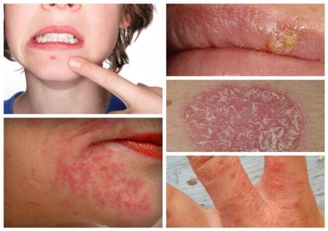 Алергиите и кожните заболявания са признаци на паразити в тялото