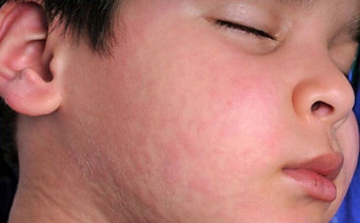 Алергични обриви по кожата - симптом за наличието на паразитни червеи в тялото